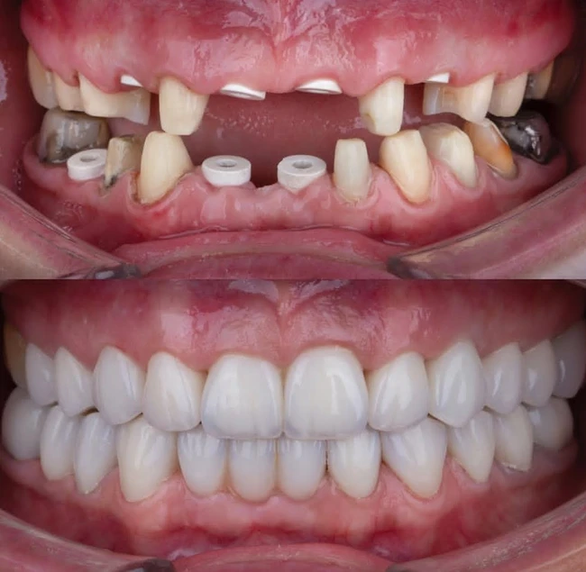 دکتر عزیز گشاده رو - متخصص پروتز و ایمپلنت دندان