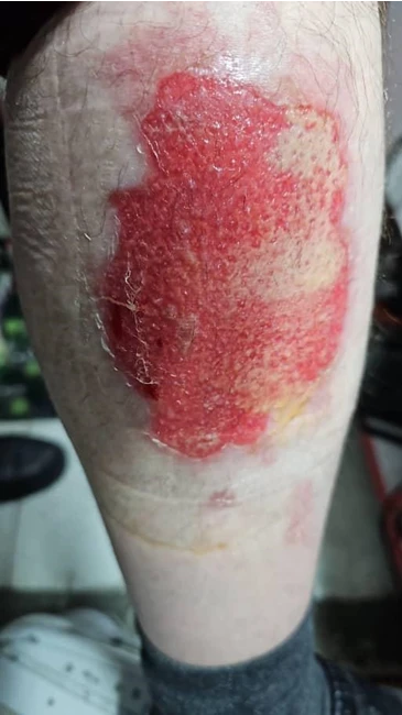 تزریقات پانسمان نوین زخم بستر ویزیت در منزل 