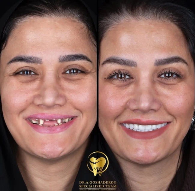 دکتر عزیز گشاده رو - متخصص پروتز و ایمپلنت دندان