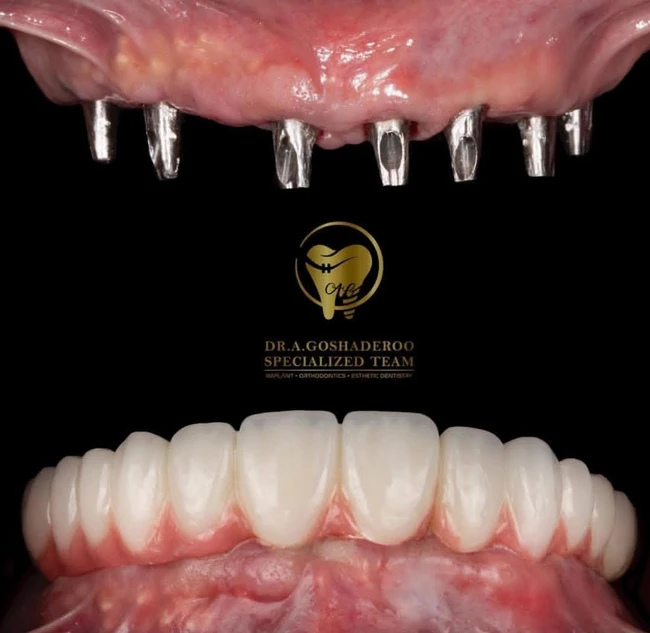 دکتر عزیز گشاده رو - متخصص پروتز و ایمپلنت دندان