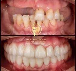 دکتر عزیز گشاده رو - متخصص پروتز و ایمپلنت دندان