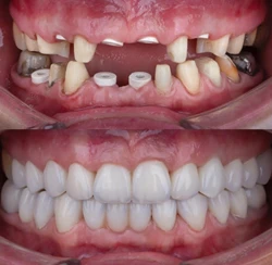 دکتر عزیز گشاده رو - متخصص پروتز و ایمپلنت دندان