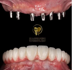 دکتر عزیز گشاده رو - متخصص پروتز و ایمپلنت دندان