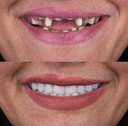 دکتر عزیز گشاده رو - متخصص پروتز و ایمپلنت دندان