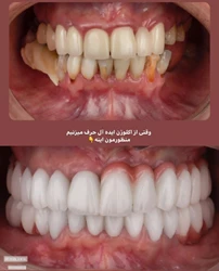 دکتر عزیز گشاده رو - متخصص پروتز و ایمپلنت دندان
