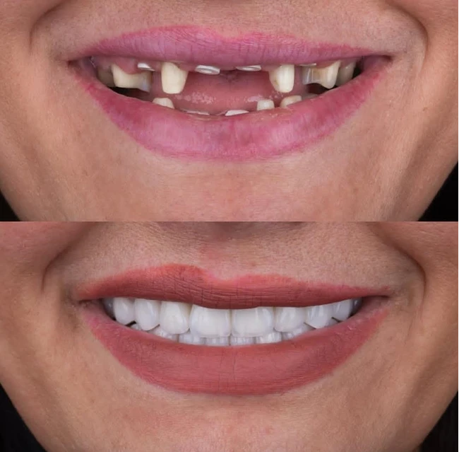 دکتر عزیز گشاده رو - متخصص پروتز و ایمپلنت دندان