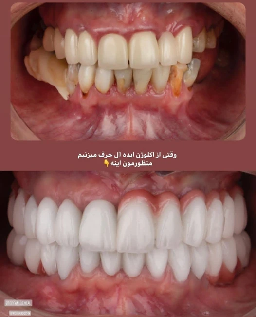 دکتر عزیز گشاده رو - متخصص پروتز و ایمپلنت دندان
