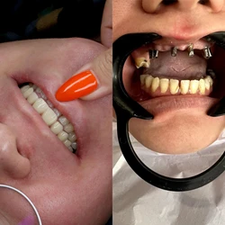 دندانپزشکی/ ایمپلنت تخصصی/ شرایط ویژه