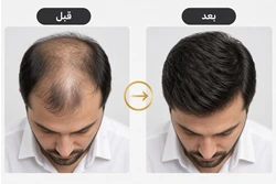 کلینیک پروتز موی آرا