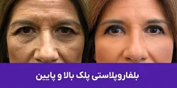 خدمات بلفاروپلاستی کلینیک کیمیا اکسیر