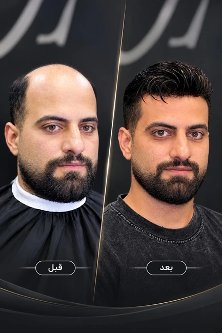 کلینیک پروتز موی آرا