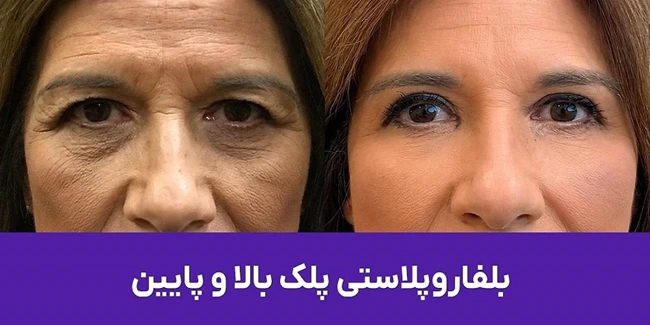 خدمات بلفاروپلاستی کلینیک کیمیا اکسیر