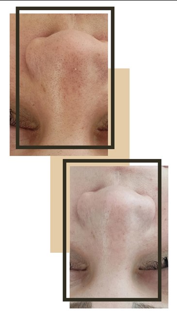 پاکسازی و فیشال پوست
