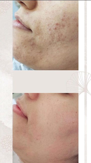 پاکسازی و فیشال پوست